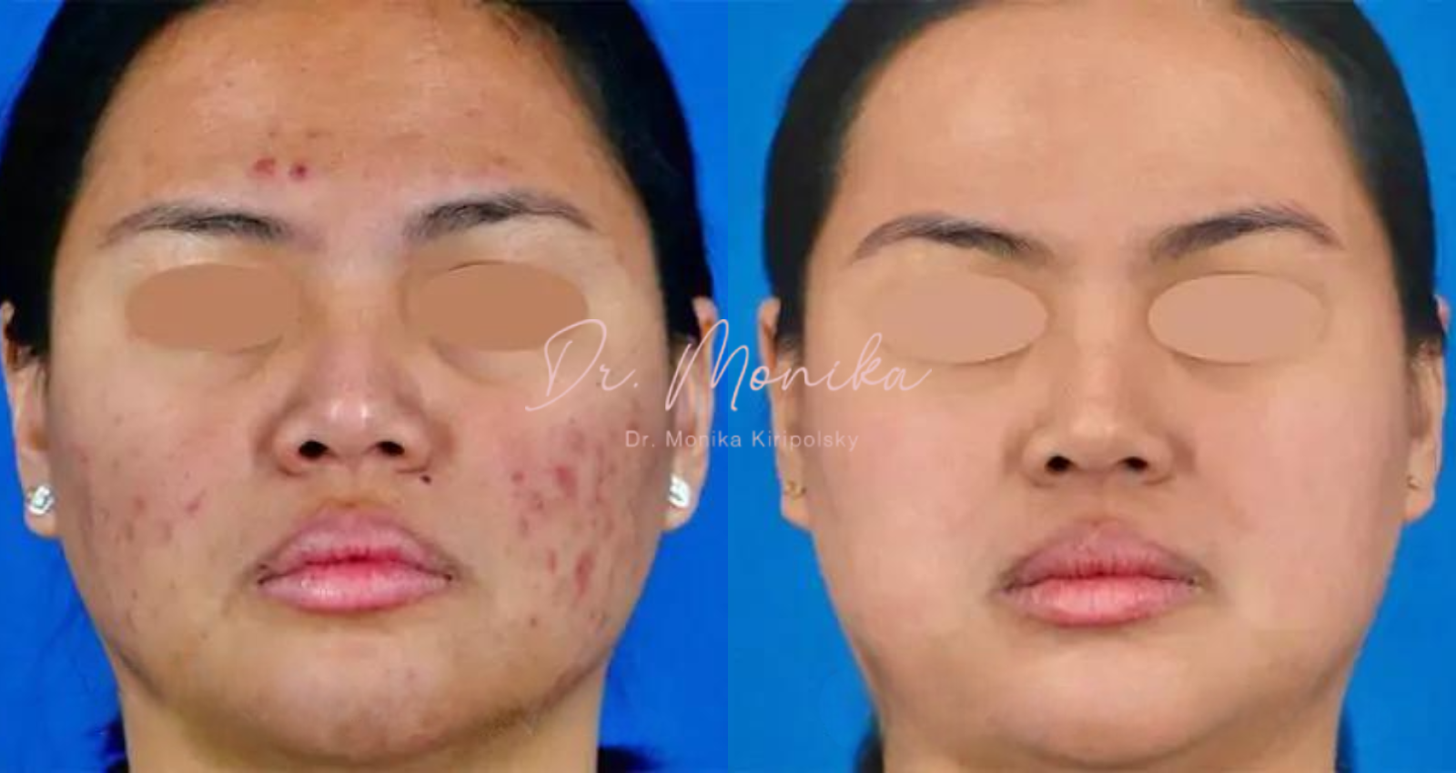 Clean, professional medical spa treatment room with neutral tones at Monika Kiripolsky, Md in Beverly Hills